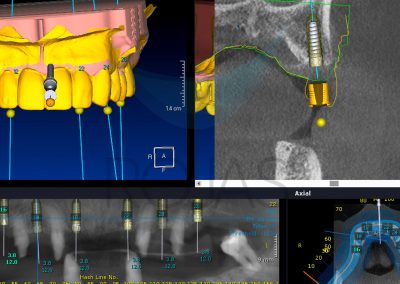 implantes-5