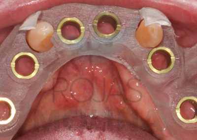 implantes-7