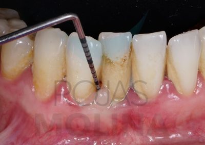 periodoncia-6