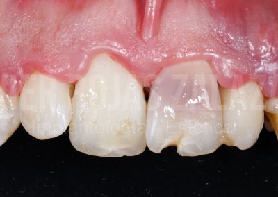 periodoncia1-5