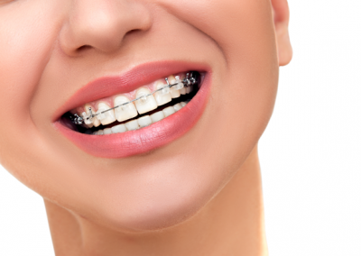 braces-dobbs-ferry-ny